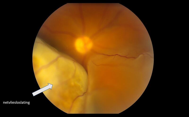 Vitrectomy